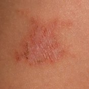 Bowel Cancer Symptoms