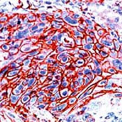 Hotchkins Lymphoma Cancer