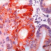 Lymphoma Cancer Symptoms