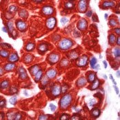 Peritoneal Cancer Symptoms Peritoneal Cancer Symptoms