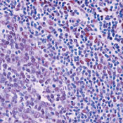 Primary Peritoneal Cancer Survival Rate Primary Peritoneal Cancer Survival Rate