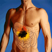 Stage 4 Uterine Cancer Stage 4 Uterine Cancer