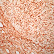 Symptoms of Tonsil Cancer Symptoms of Tonsil Cancer