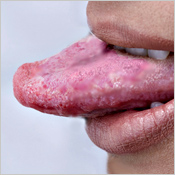 Tongue Cancer Signs