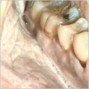 Tongue Cancer Survival Rate