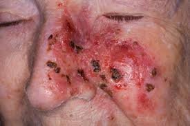 Basal Skin Cancer