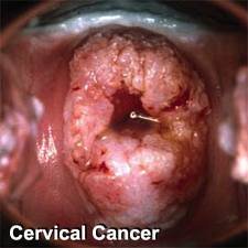 Cervical Cancer Causes