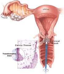 Cervical Cancer