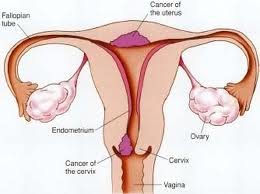 Cervical cancer stages