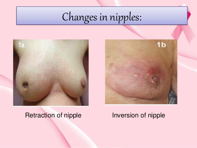 Changes in the nipple