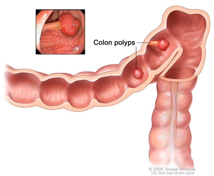 How to prevent colon cancer