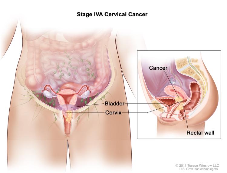 Natural ways to cure cervical cancer