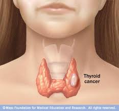Thyroid cancer symptoms